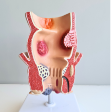 illustration Traitements laser mini-invasifs innovants en chirurgie proctologique au CHIV
